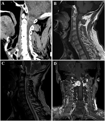 Intradural Extramedullary Nerve Sheath Myxoma of the Cervical Spine: A Case Report and Review of Literature